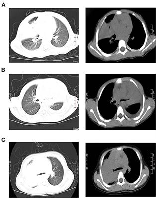 Case Report: Clinical Analysis of Fulminant Mycoplasma pneumoniae Pneumonia in Children